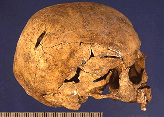 Fig. 4. The skull of Individual 10 showing the signs of the mortal blows (Pian di Civita) (Tarquinia Project).